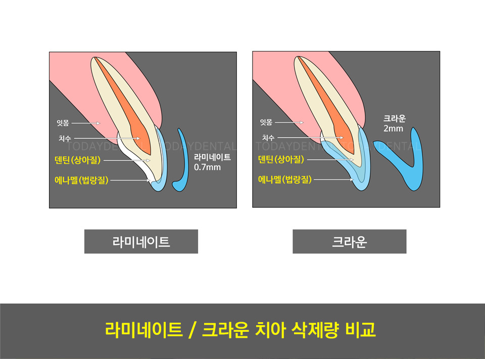 MINISH牙科|MINISH种植牙|MINISH种植牙价格|MINISH全瓷牙修复|MINISH牙科医院|MINISH牙齿贴面|韩国牙科医院|韩国牙齿整形医院|韩国牙齿美容医院|韩国牙科整形价格