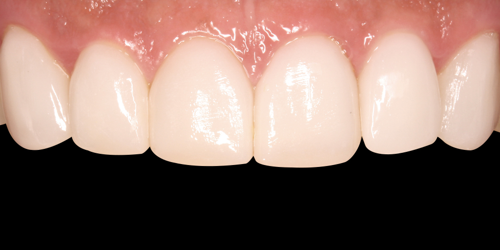 MINISH牙科|MINISH种植牙|MINISH种植牙价格|MINISH全瓷牙修复|MINISH牙科医院|MINISH牙齿贴面|韩国牙科医院|韩国牙齿整形医院|韩国牙齿美容医院|韩国牙科整形价格