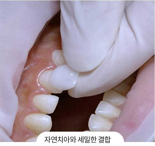 자연치아