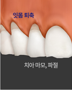 이갈이가 심한 치아