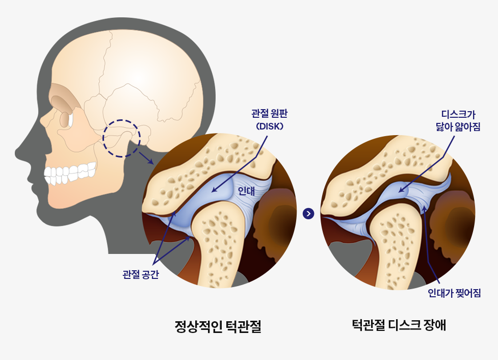 턱관절장애로인한증상