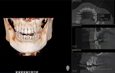 cbct