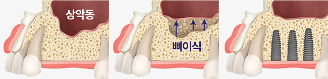 상악동 거상술