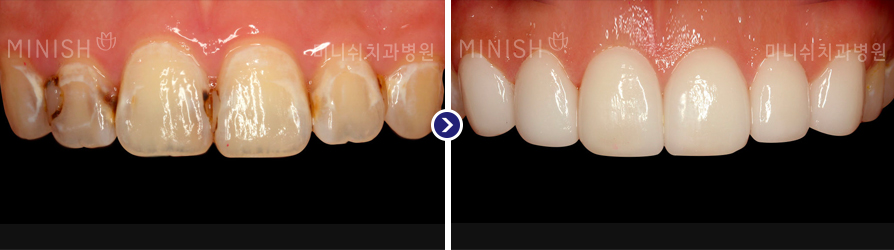 교정 후 충치 