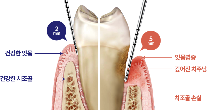 치주치료 원인 