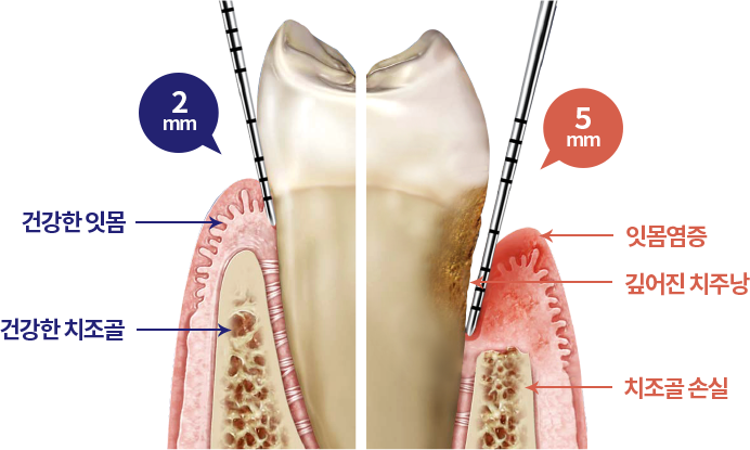 치주치료 원인 