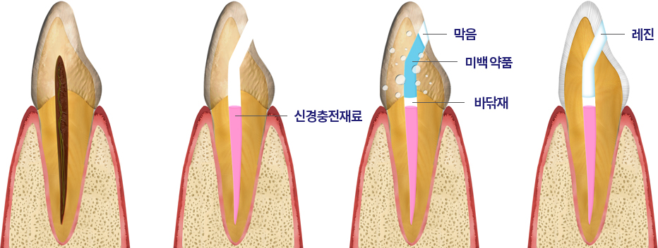 실활치 미백 단계