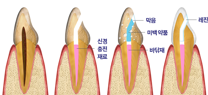 실활치 미백 단계